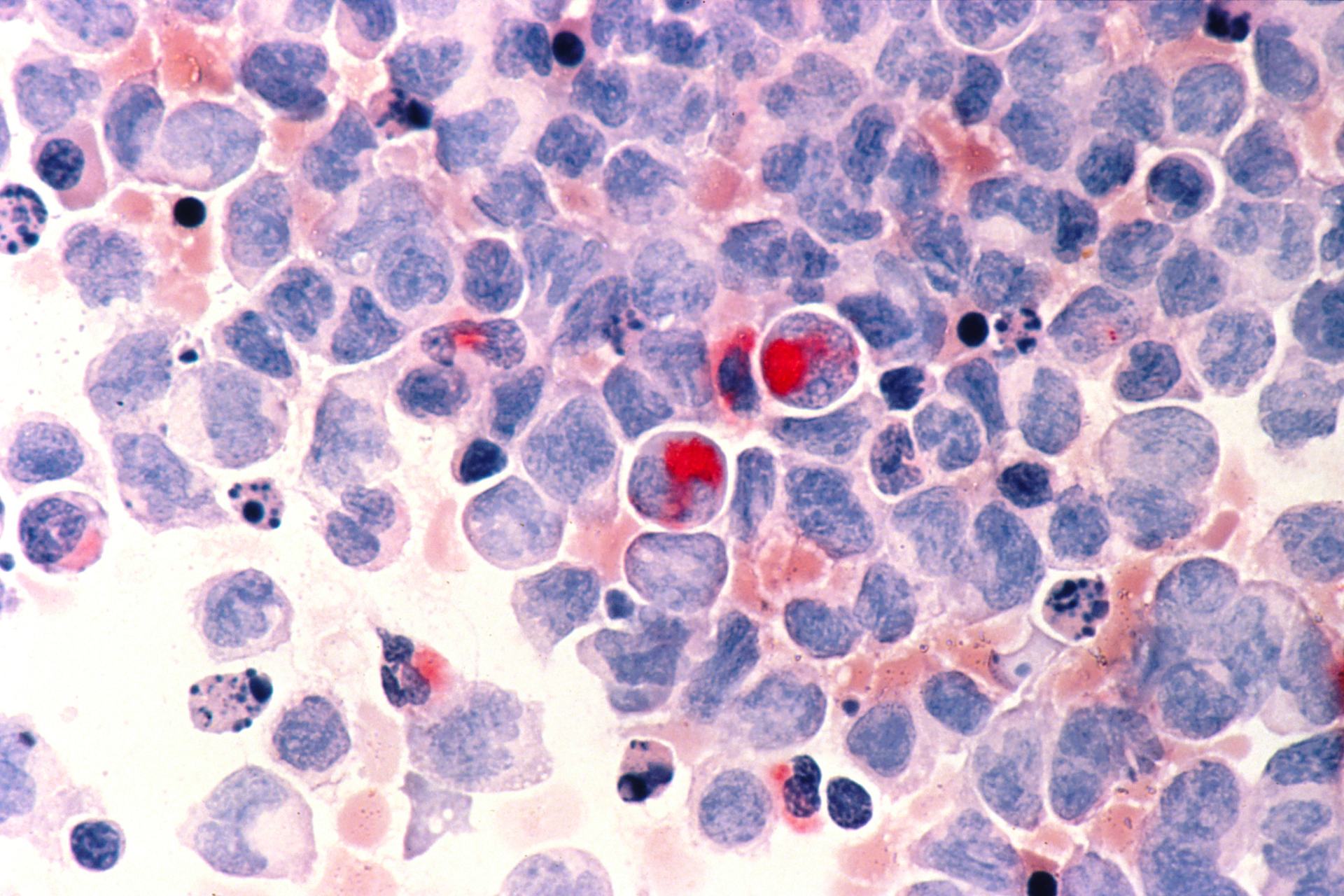 Predicting leukemia in myelodysplastic syndromes