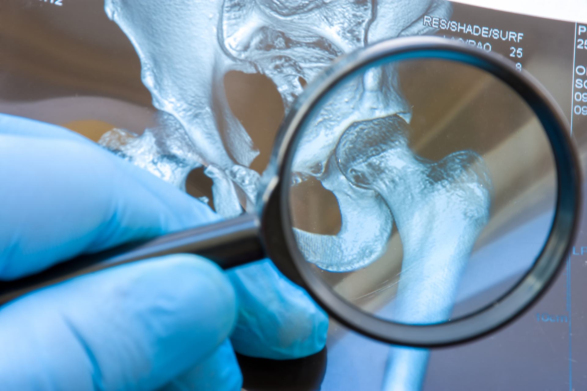 World Arthritis Day: understanding rheumatoid arthritis from the inside to build more effective therapies