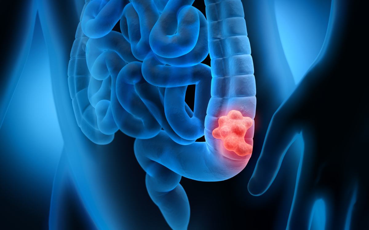 Innate immunity and liver metastases: a new key to colorectal cancer